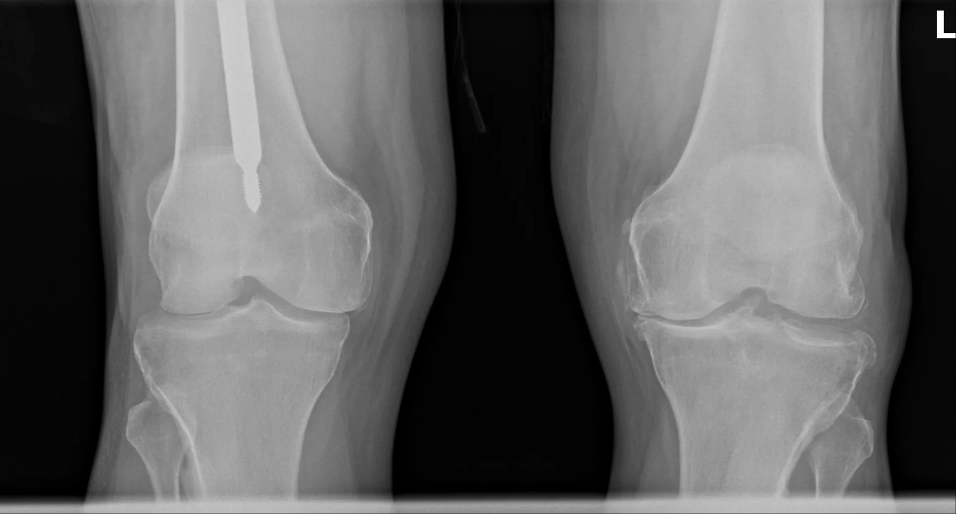 X-ray image of a knee joint showing bone-on-bone osteoarthritis
