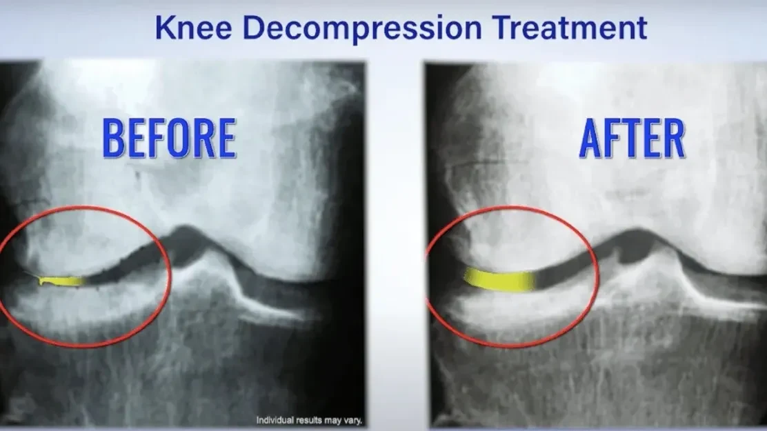Knee decompression before and after X-ray comparison. Individual results may vary.