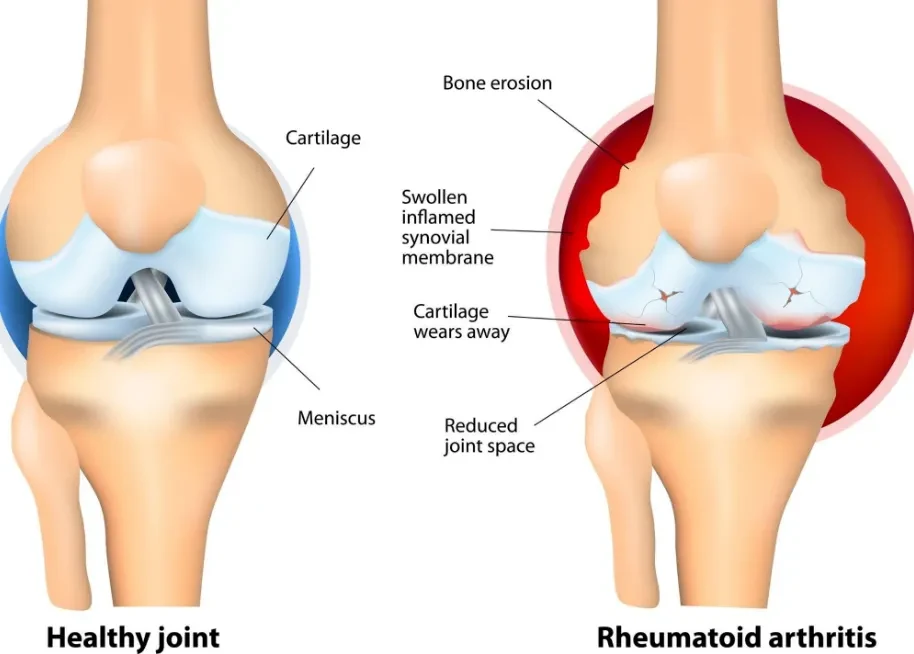 Diagram comparing a healthy knee joint with an arthritic knee showing bone erosion, worn cartilage, and reduced joint space