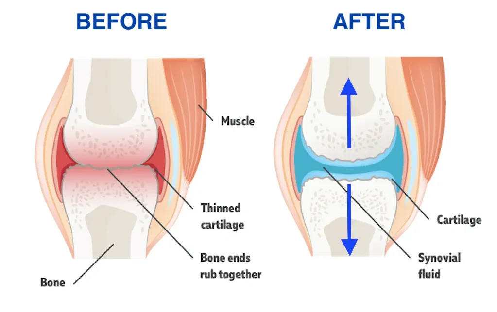Diagram: before decompression the cartilage is thinned and bone ends rub together; after, the joint space reopens and fills with synovial fluid